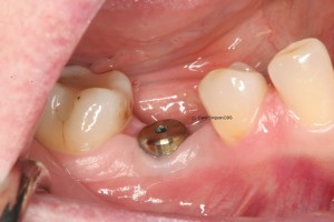 Implant with healing abutment