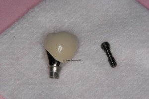 Implant crown before placement