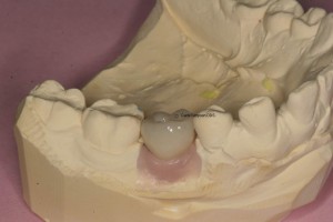 Implant crown on dental model