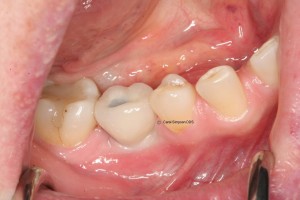 Dental implant crown replacement