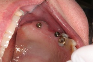 Two dental implants for bridge