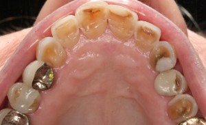 Severe dental erosion before restoration with crowns