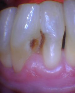 Dental root caries resulting from dry mouth