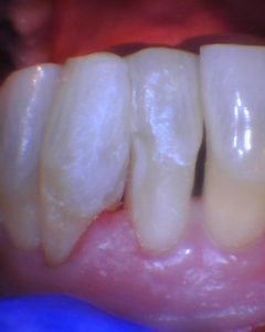 Dental root caries from dry mouth - restored